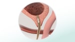 Stress incontinence: Fast Facts