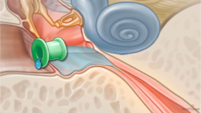 Ear Infections | Kaiser Permanente