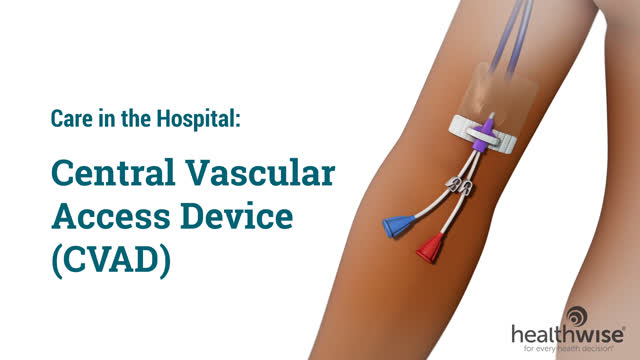 Implanted Venous Access Device (Port)